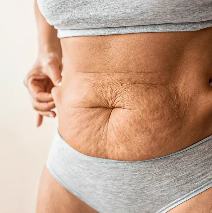 Abdominoplastia-Mobile