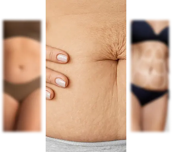 Detalhe-Abdominoplastia