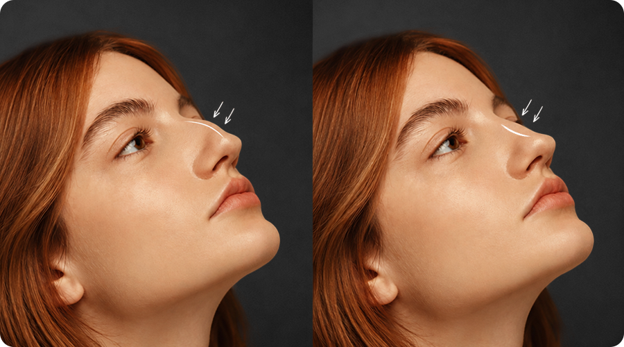 Tudo sobre a rinoplastia estruturada e resultados naturais